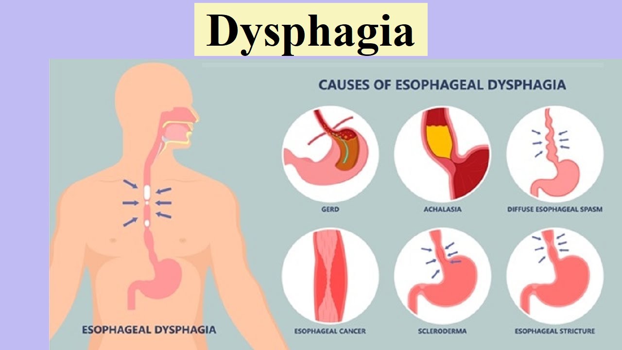 Esophageal dysphagia