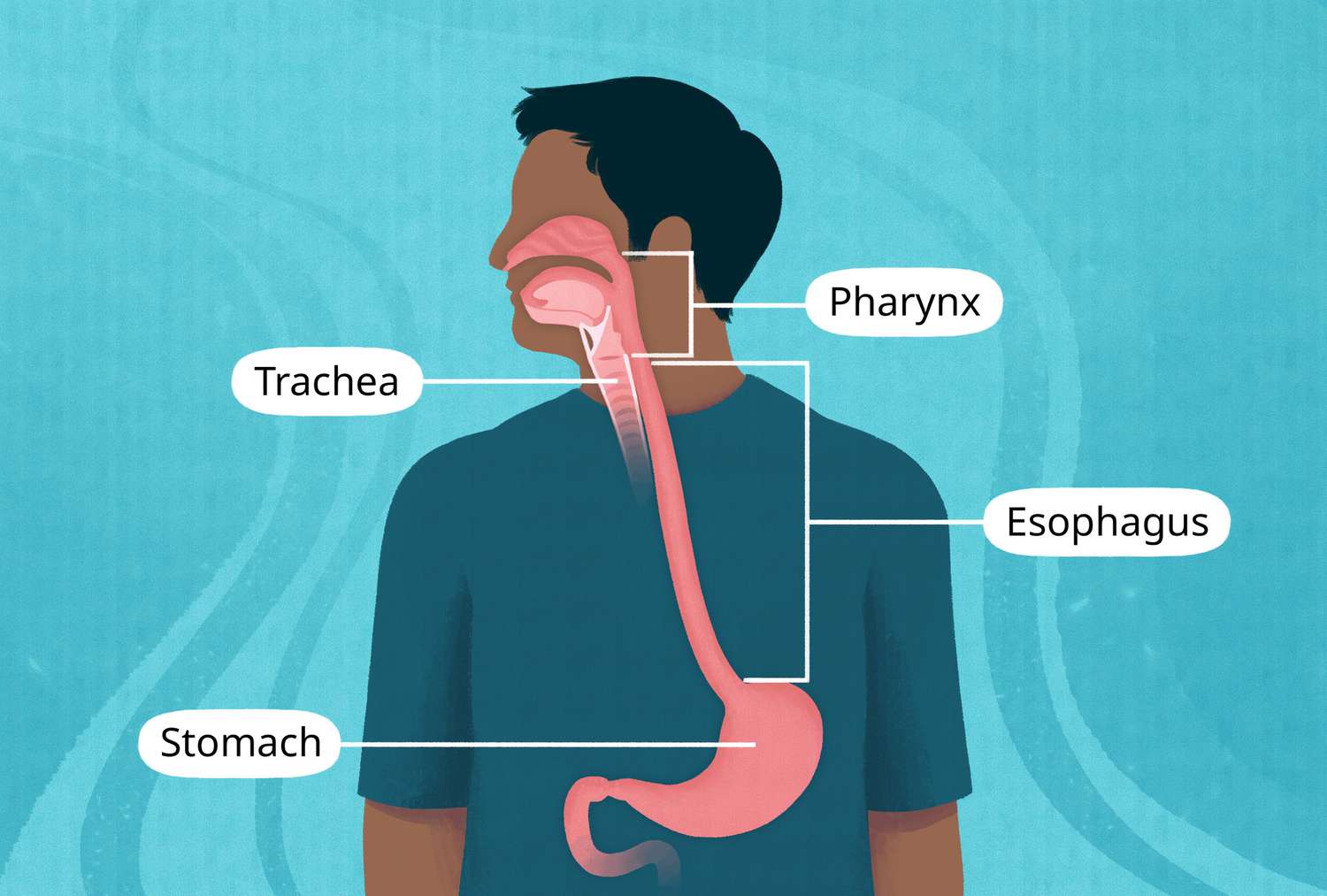 Oropharyngeal dysphagia