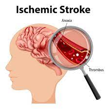 Ischemic Stroke